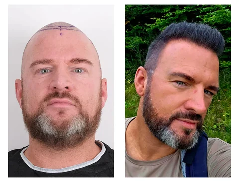 Hair transplant before-and-after patient result 3