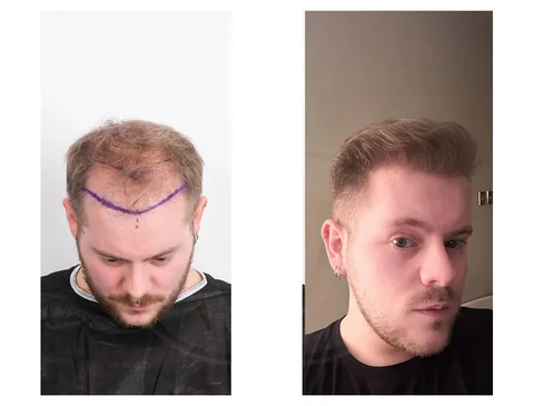 Hair transplant before-and-after patient result 4