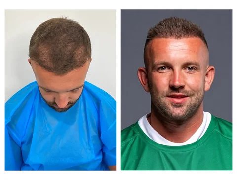Hair transplant before-and-after patient result 2