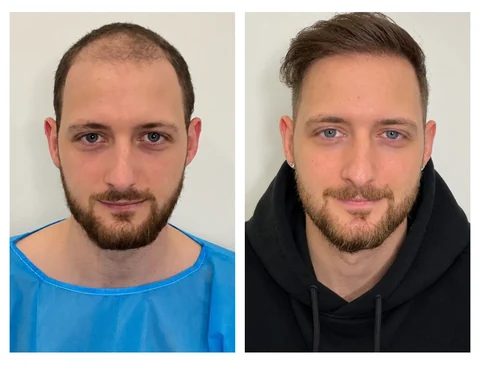 Hair transplant before-and-after patient result 1