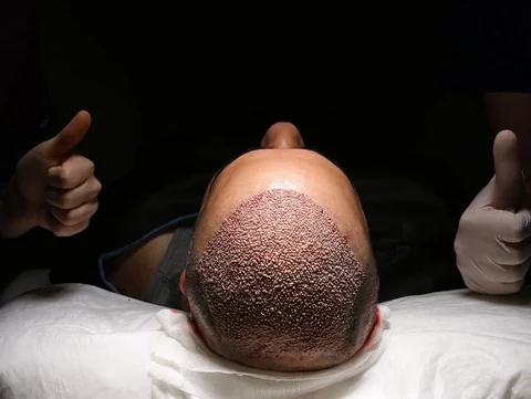 Explore hair restoration treatment options