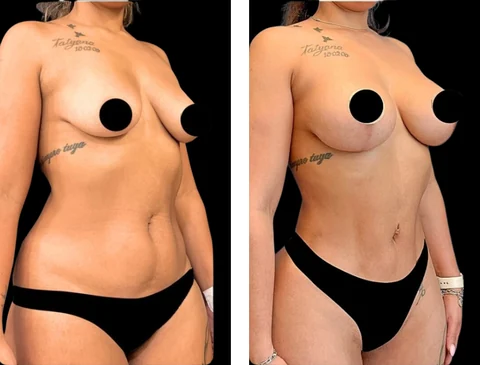 Mommy makeover patient before-and-after photographs