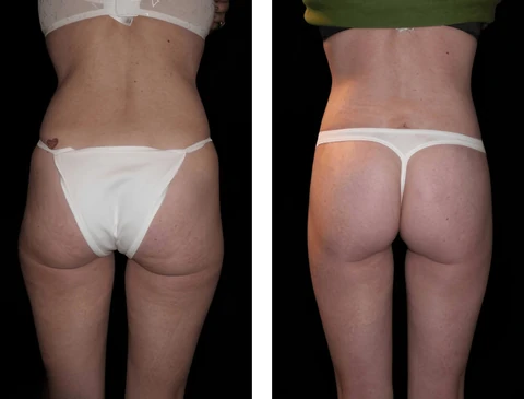 Thigh lift patient before-and-after photographs