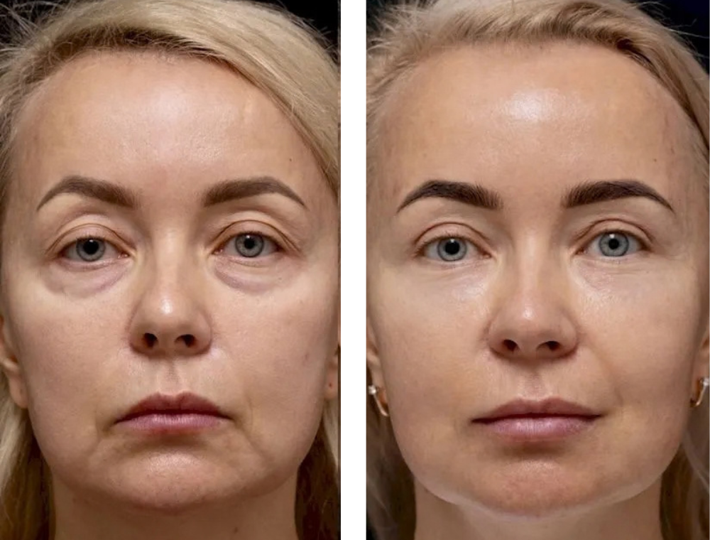 Eyelid surgery before and after comparison, patient example 4