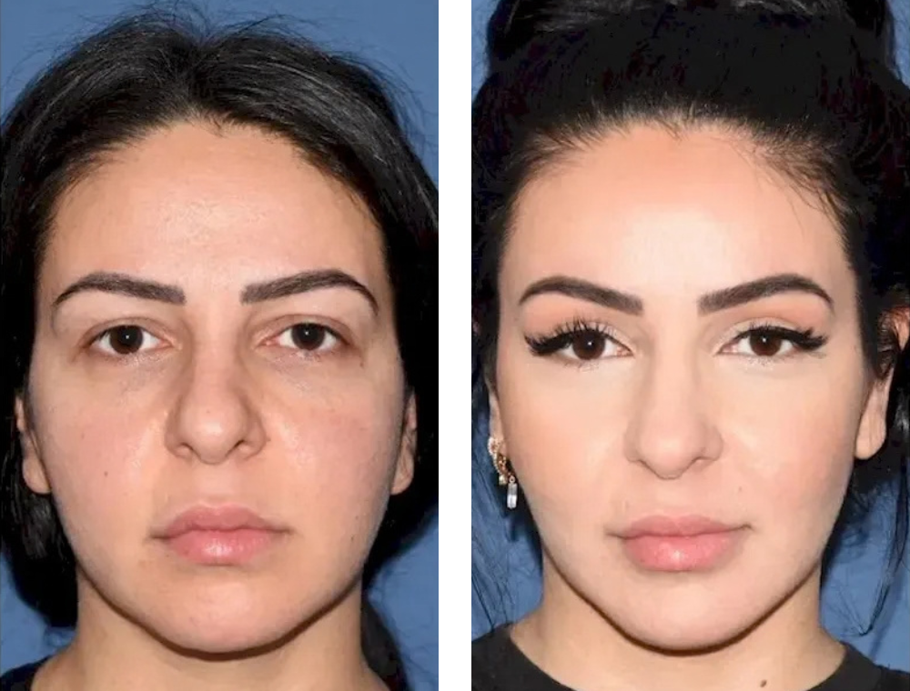Eyelid surgery before and after comparison, patient example 3