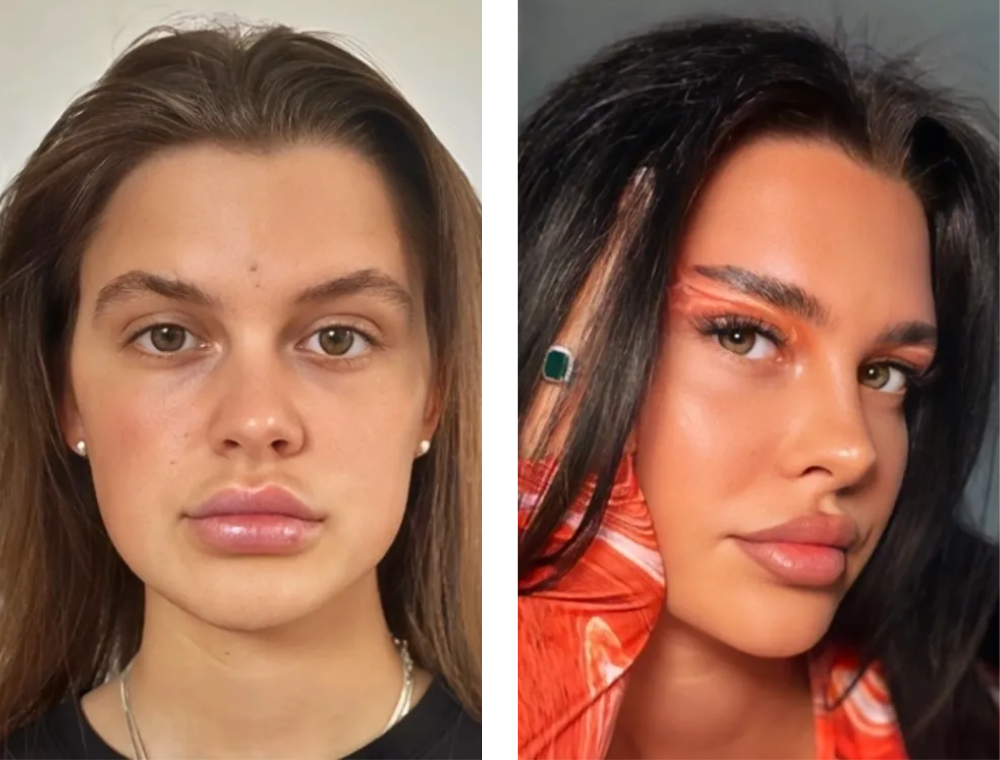 Eyelid surgery before and after comparison, patient example 1