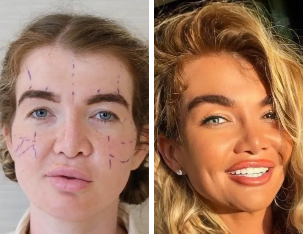 Eyelid surgery before and after comparison, patient example 5