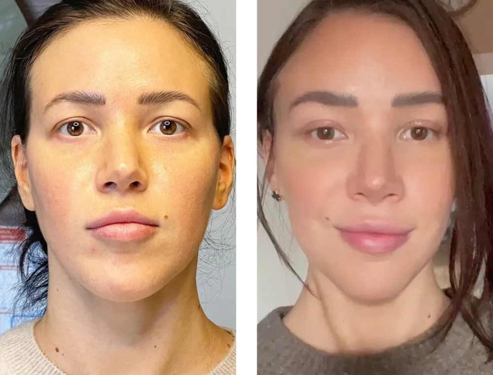 Eyelid surgery before and after comparison, patient example 2