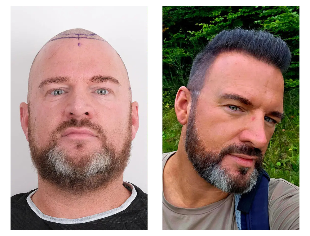 Hair transplant before-and-after patient result 3