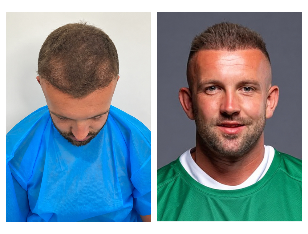 Hair transplant before-and-after patient result 2