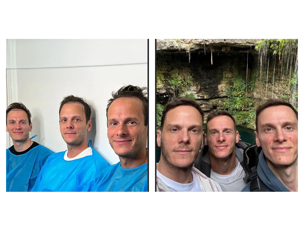 Hair transplant before and after comparison — patient example 5