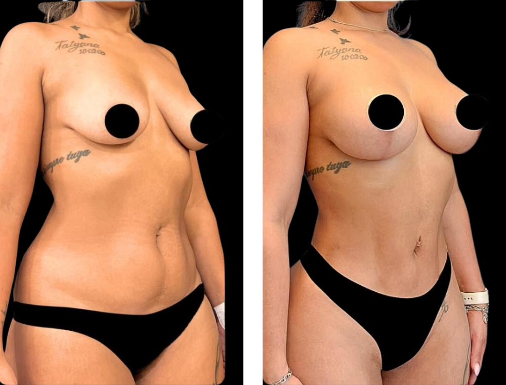 Mommy makeover patient before-and-after photographs