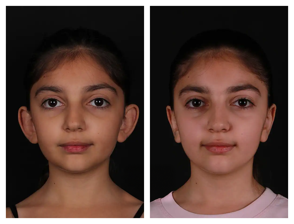 Otoplasty before and after comparison, patient example 1