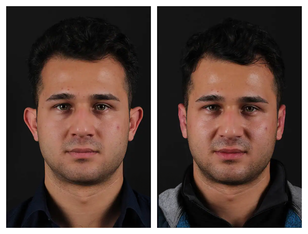 Otoplasty before and after comparison, patient example 6
