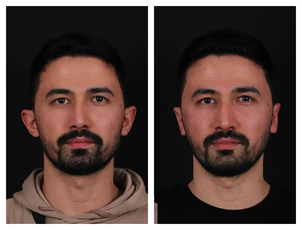 Otoplasty before and after comparison, patient example 4
