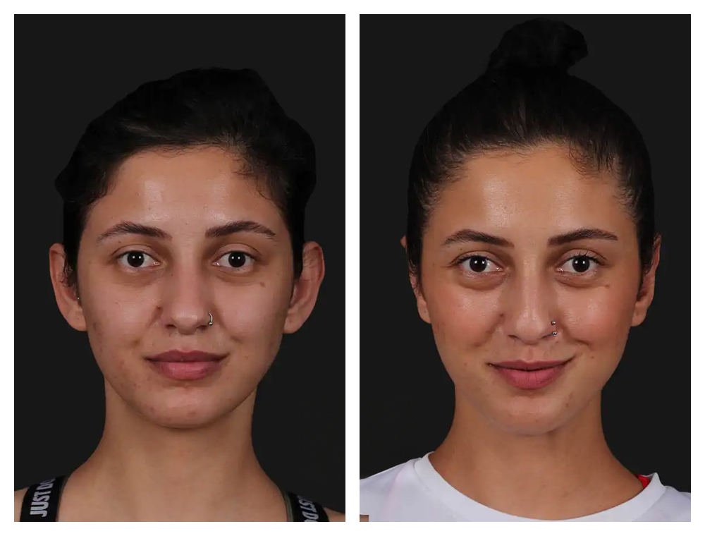 Otoplasty before and after comparison, patient example 3