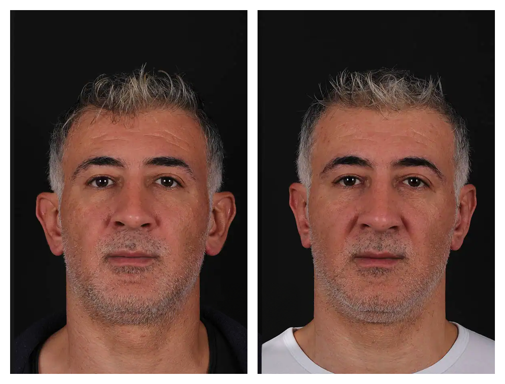 Otoplasty before and after comparison, patient example 5