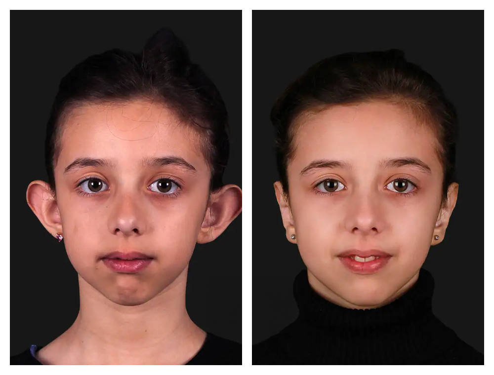 Otoplasty before and after comparison, patient example 2