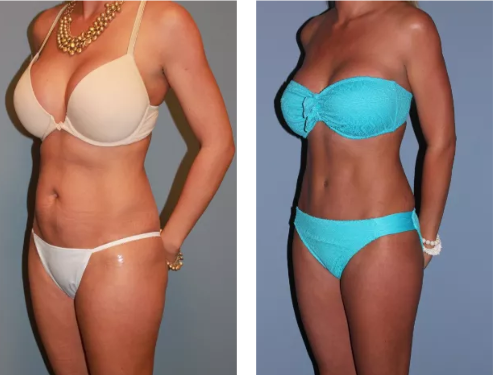 Tummy tuck patient before-and-after photographs