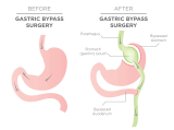 Dumping Syndrome After Gastric Bypass: Symptoms, Food Triggers and Prevention