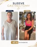 Gastric Sleeve Surgery