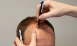 Hair Transplant Costs